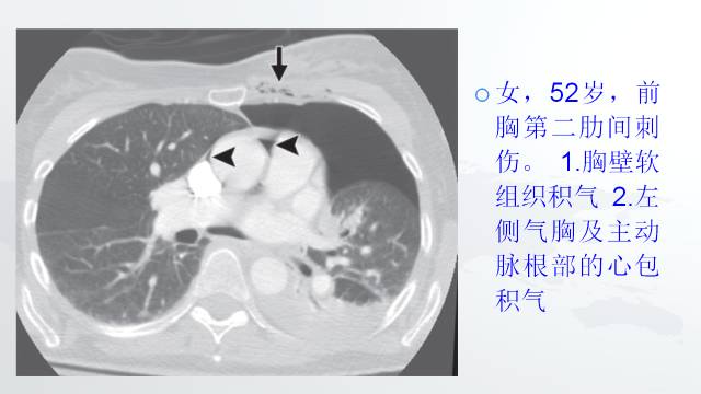 【PPT】穿透性经纵隔损伤的影像学评估