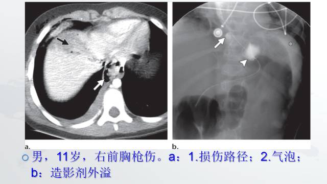 【PPT】穿透性经纵隔损伤的影像学评估