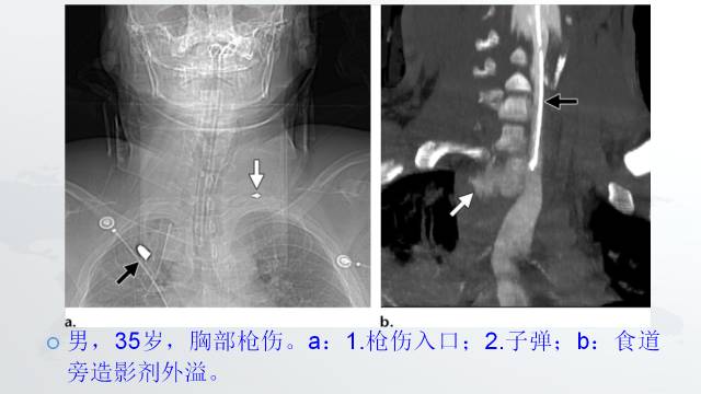 【PPT】穿透性经纵隔损伤的影像学评估