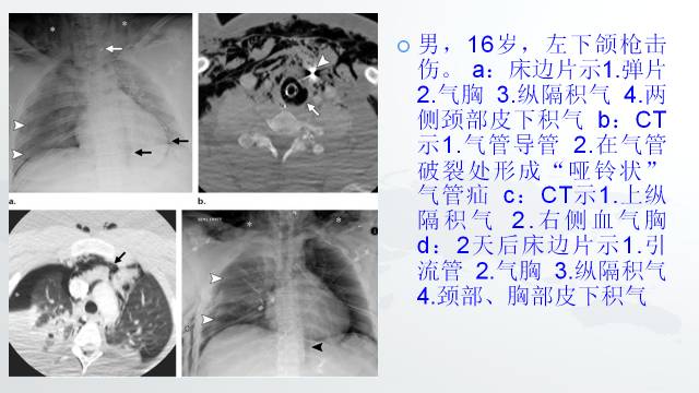 【PPT】穿透性经纵隔损伤的影像学评估