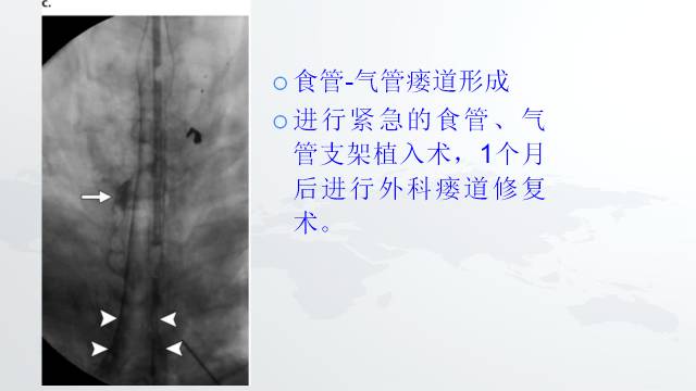 【PPT】穿透性经纵隔损伤的影像学评估