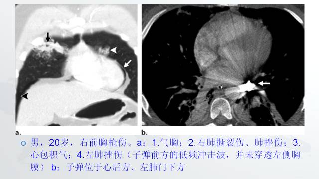 【PPT】穿透性经纵隔损伤的影像学评估