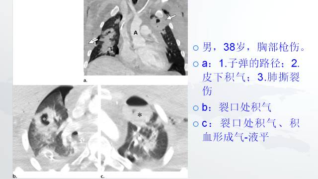 【PPT】穿透性经纵隔损伤的影像学评估