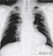 “肋骨切迹征” 的影像表现与临床意义 “肋骨切迹征” 的影像表现与临床意义