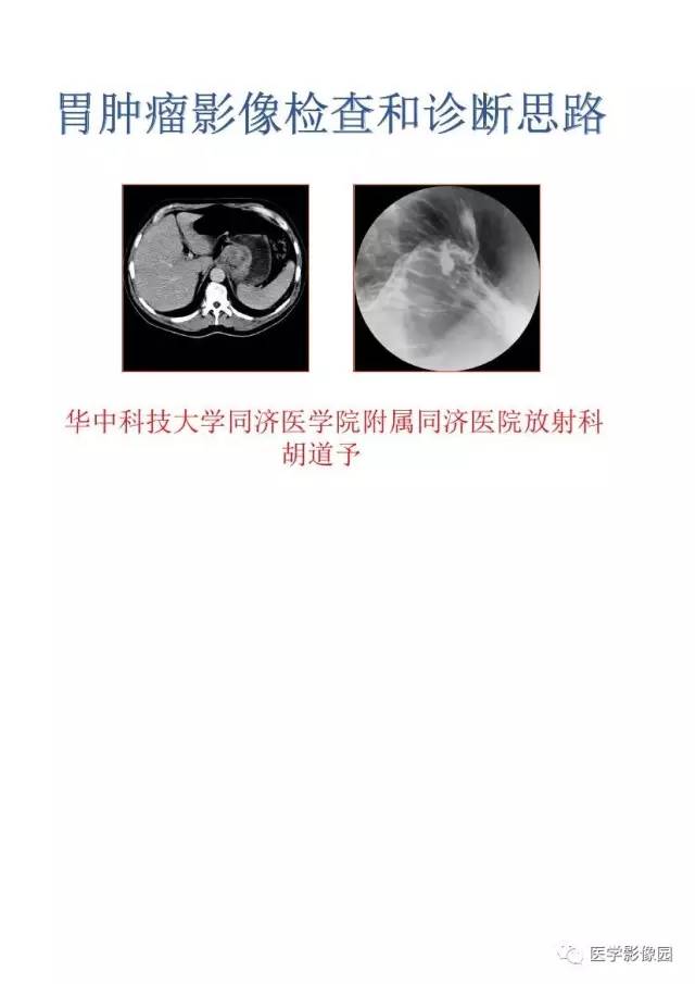 【PPT】胃肿瘤影像检查和诊断思路