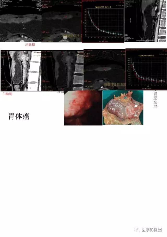 【PPT】胃肿瘤影像检查和诊断思路