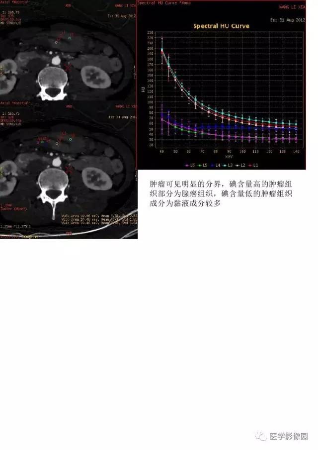 【PPT】胃肿瘤影像检查和诊断思路