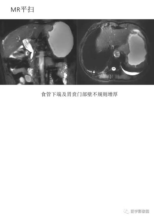 【PPT】胃肿瘤影像检查和诊断思路