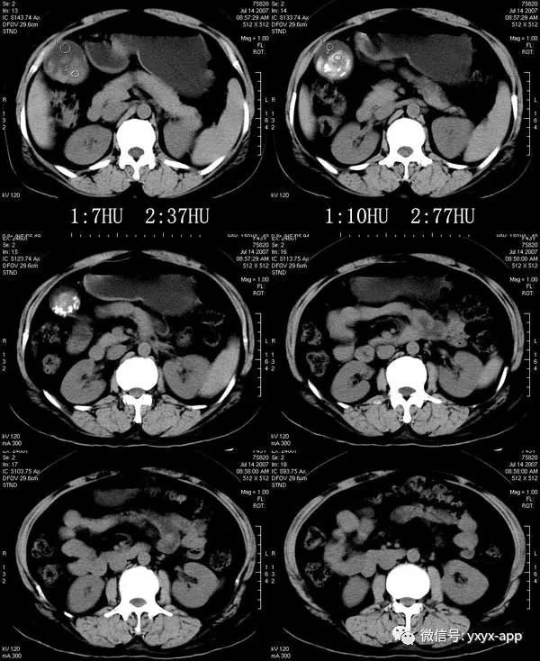 【病例】胆囊炎并胆囊结石1例CT 【病例】胆囊炎并胆囊结石1例CT
