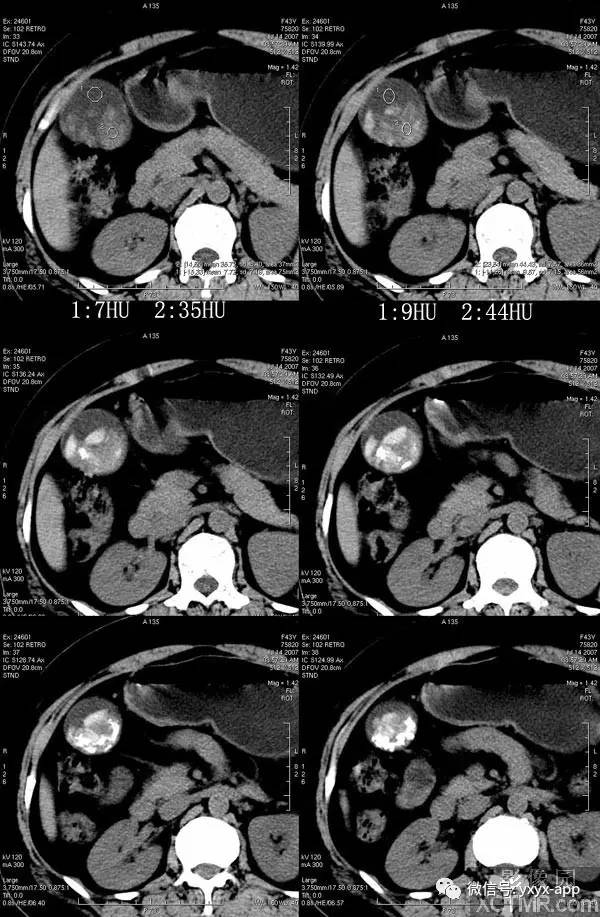 【病例】胆囊炎并胆囊结石1例CT