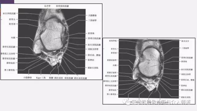 【PPT】踝关节解剖及正常MR表现