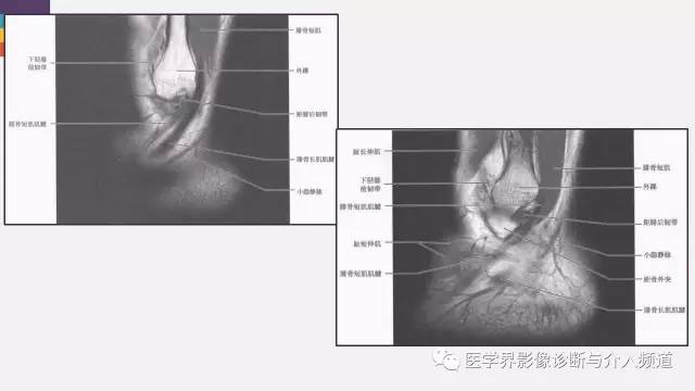 【PPT】踝关节解剖及正常MR表现