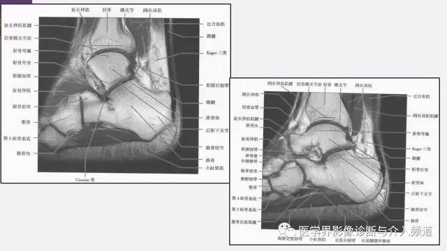 【PPT】踝关节解剖及正常MR表现