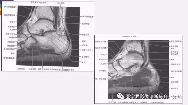 【PPT】踝关节解剖及正常MR表现