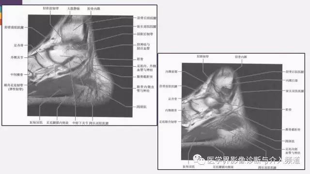 【PPT】踝关节解剖及正常MR表现