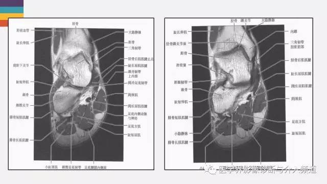 【PPT】踝关节解剖及正常MR表现