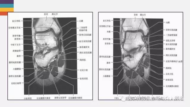 【PPT】踝关节解剖及正常MR表现