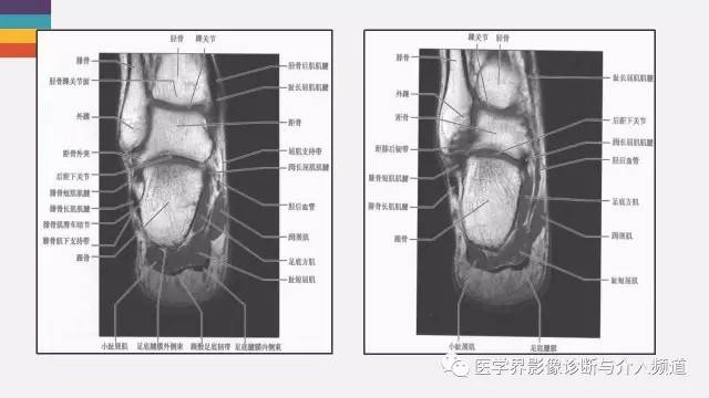 【PPT】踝关节解剖及正常MR表现