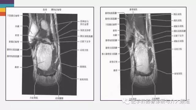 【PPT】踝关节解剖及正常MR表现