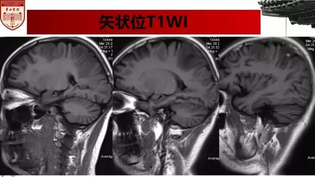 【病例】SLE继发可逆性后部脑病综合征1例MR 【病例】SLE继发可逆性后部脑病综合征1例MR