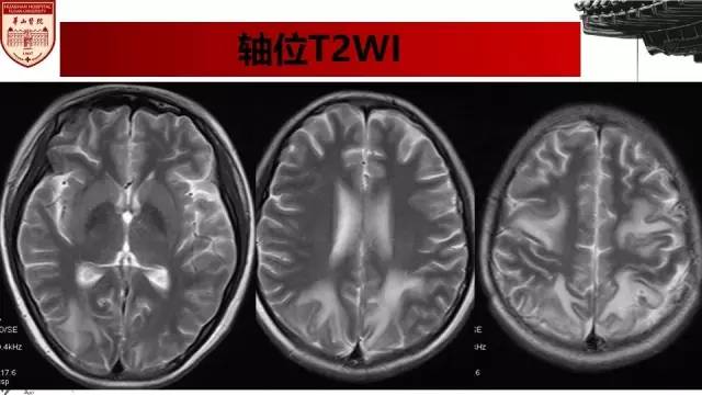 【病例】SLE继发可逆性后部脑病综合征1例MR 【病例】SLE继发可逆性后部脑病综合征1例MR