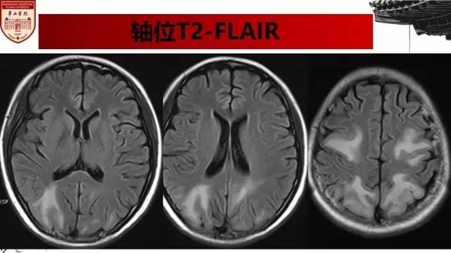 【病例】SLE继发可逆性后部脑病综合征1例MR 【病例】SLE继发可逆性后部脑病综合征1例MR