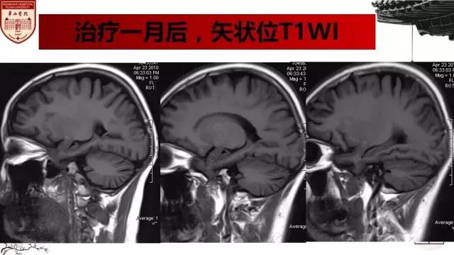 【病例】SLE继发可逆性后部脑病综合征1例MR 【病例】SLE继发可逆性后部脑病综合征1例MR