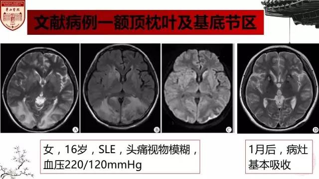 【病例】SLE继发可逆性后部脑病综合征1例MR 【病例】SLE继发可逆性后部脑病综合征1例MR