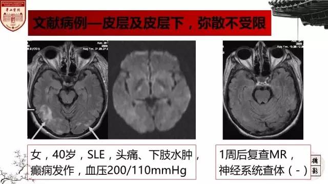 【病例】SLE继发可逆性后部脑病综合征1例MR 【病例】SLE继发可逆性后部脑病综合征1例MR
