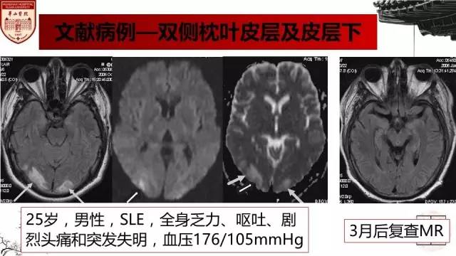 【病例】SLE继发可逆性后部脑病综合征1例MR 【病例】SLE继发可逆性后部脑病综合征1例MR