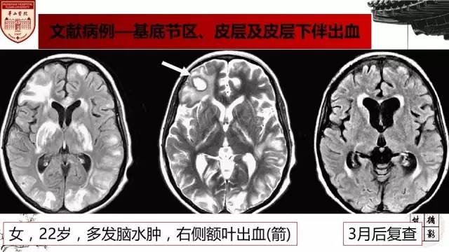 【病例】SLE继发可逆性后部脑病综合征1例MR 【病例】SLE继发可逆性后部脑病综合征1例MR