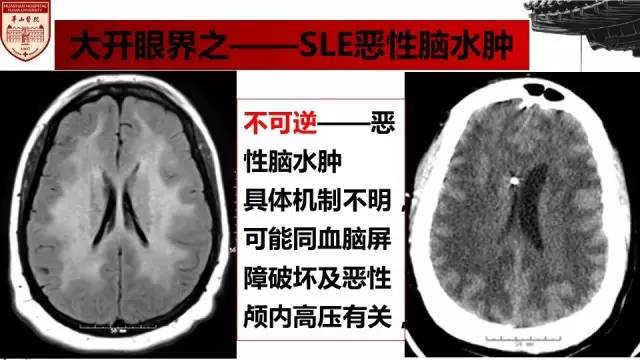 【病例】SLE继发可逆性后部脑病综合征1例MR 【病例】SLE继发可逆性后部脑病综合征1例MR