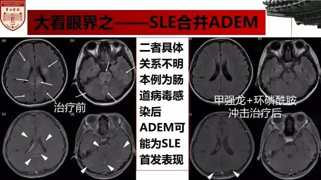 【病例】SLE继发可逆性后部脑病综合征1例MR 【病例】SLE继发可逆性后部脑病综合征1例MR