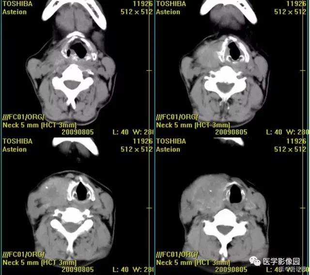 【病例】原发性甲状腺血管肉瘤1例CT影像表现 【病例】原发性甲状腺血管肉瘤1例CT影像表现