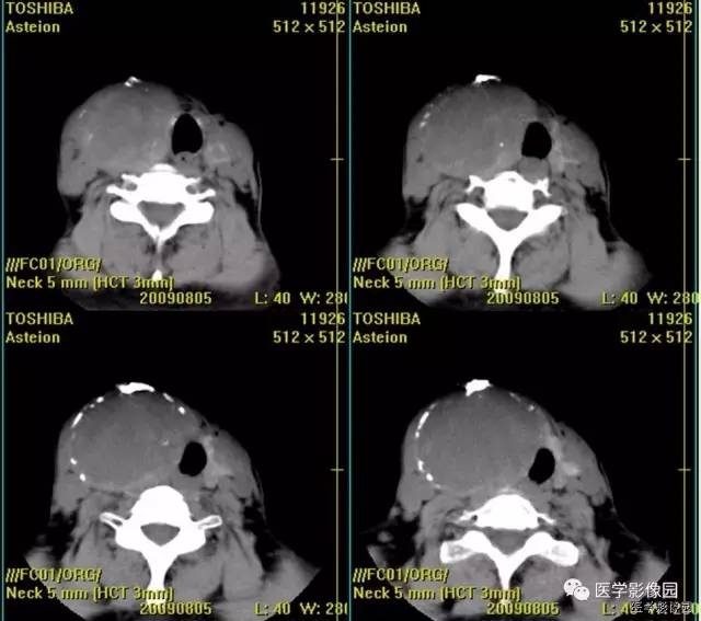 【病例】原发性甲状腺血管肉瘤1例CT影像表现 【病例】原发性甲状腺血管肉瘤1例CT影像表现