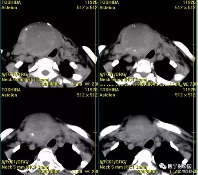 【病例】原发性甲状腺血管肉瘤1例CT影像表现 【病例】原发性甲状腺血管肉瘤1例CT影像表现