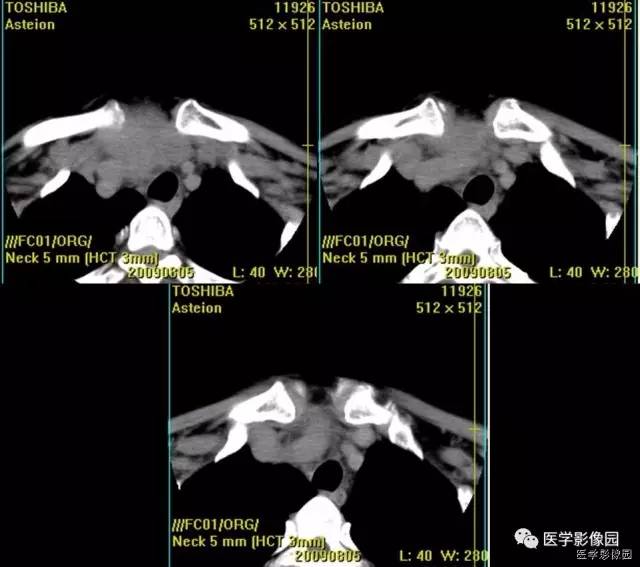 【病例】原发性甲状腺血管肉瘤1例CT影像表现 【病例】原发性甲状腺血管肉瘤1例CT影像表现