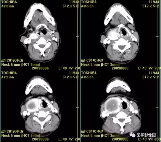 【病例】原发性甲状腺血管肉瘤1例CT影像表现 【病例】原发性甲状腺血管肉瘤1例CT影像表现