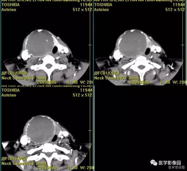 【病例】原发性甲状腺血管肉瘤1例CT影像表现 【病例】原发性甲状腺血管肉瘤1例CT影像表现