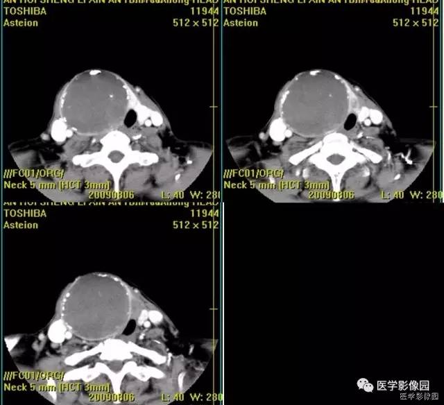 【病例】原发性甲状腺血管肉瘤1例CT影像表现 【病例】原发性甲状腺血管肉瘤1例CT影像表现