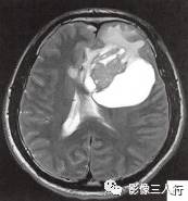 【病例】左侧额叶神经母细胞瘤1例MR影像表现分析