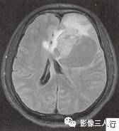 【病例】左侧额叶神经母细胞瘤1例MR影像表现分析 【病例】左侧额叶神经母细胞瘤1例MR影像表现分析