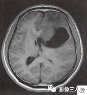 【病例】左侧额叶神经母细胞瘤1例MR影像表现分析 【病例】左侧额叶神经母细胞瘤1例MR影像表现分析
