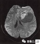 【病例】左侧额叶神经母细胞瘤1例MR影像表现分析 【病例】左侧额叶神经母细胞瘤1例MR影像表现分析