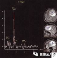【病例】左侧额叶神经母细胞瘤1例MR影像表现分析 【病例】左侧额叶神经母细胞瘤1例MR影像表现分析