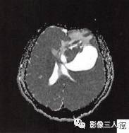 【病例】左侧额叶神经母细胞瘤1例MR影像表现分析 【病例】左侧额叶神经母细胞瘤1例MR影像表现分析