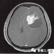【病例】左侧额叶神经母细胞瘤1例MR影像表现分析 【病例】左侧额叶神经母细胞瘤1例MR影像表现分析