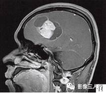【病例】左侧额叶神经母细胞瘤1例MR影像表现分析 【病例】左侧额叶神经母细胞瘤1例MR影像表现分析