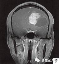 【病例】左侧额叶神经母细胞瘤1例MR影像表现分析 【病例】左侧额叶神经母细胞瘤1例MR影像表现分析