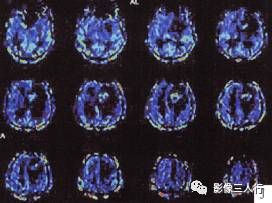 【病例】左侧额叶神经母细胞瘤1例MR影像表现分析 【病例】左侧额叶神经母细胞瘤1例MR影像表现分析